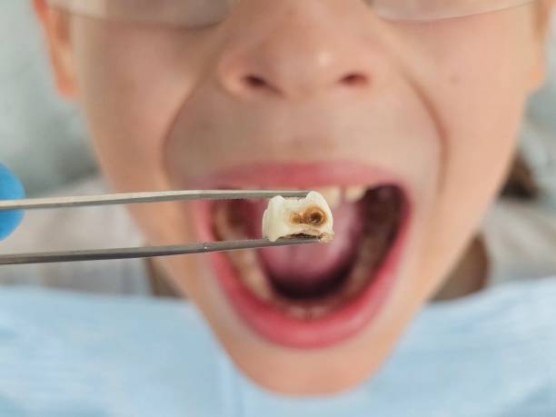 Best Emergency Tooth Extraction in Salado, TX